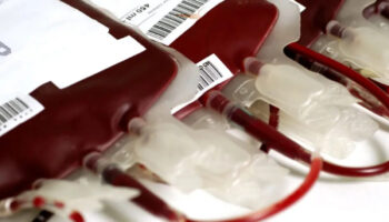 Epatite C: sì al risarcimento se l’emotrasfusione è la “probabilità prevalente”